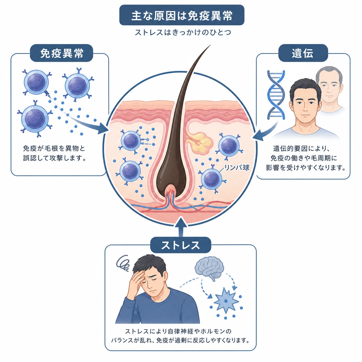 円形脱毛症の主な原因となる免疫異常と複数の要因の関係を表した医療イラスト
