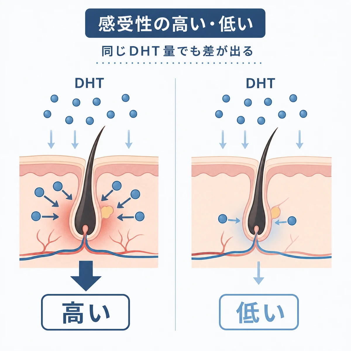 感受性が高い受容体と低い受容体で脱毛シグナルの強さが変わる違いを表した医療イラスト