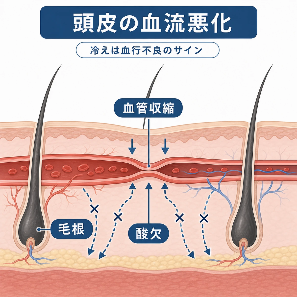 交感神経の緊張で頭皮の毛細血管が収縮し毛根へ血流が届きにくくなる様子を表した医療イラスト