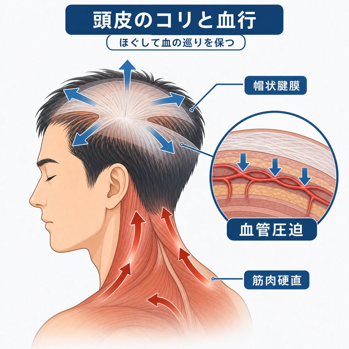 頭部の筋肉の緊張で帽状腱膜が硬くなり頭皮の血管が圧迫される様子を表した医療イラスト