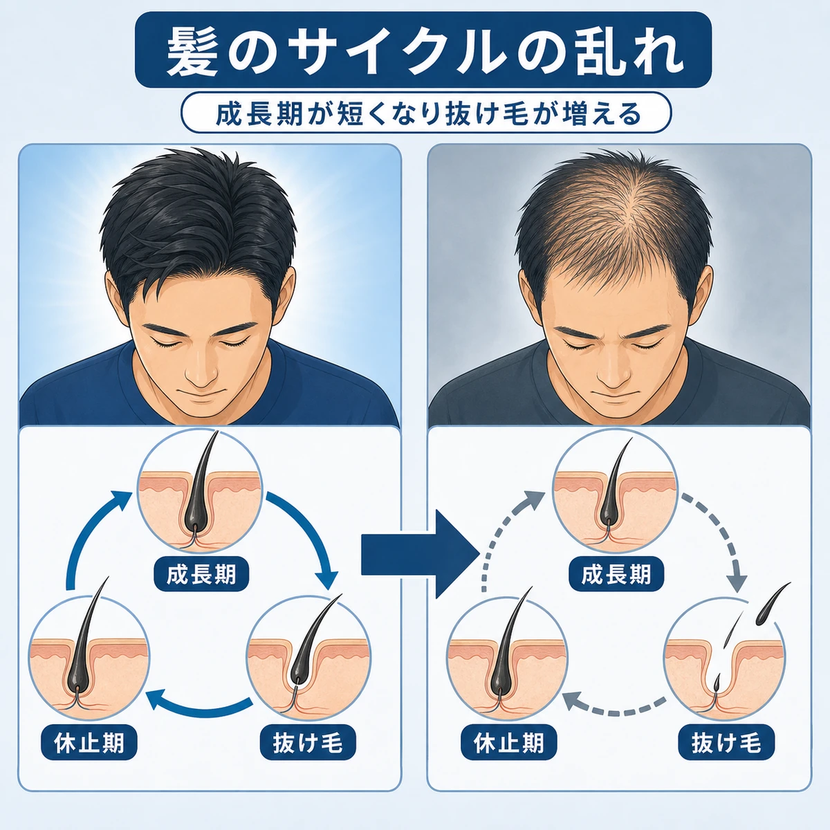 コルチゾール過剰でヘアサイクルが乱れる様子を表した医療イラスト