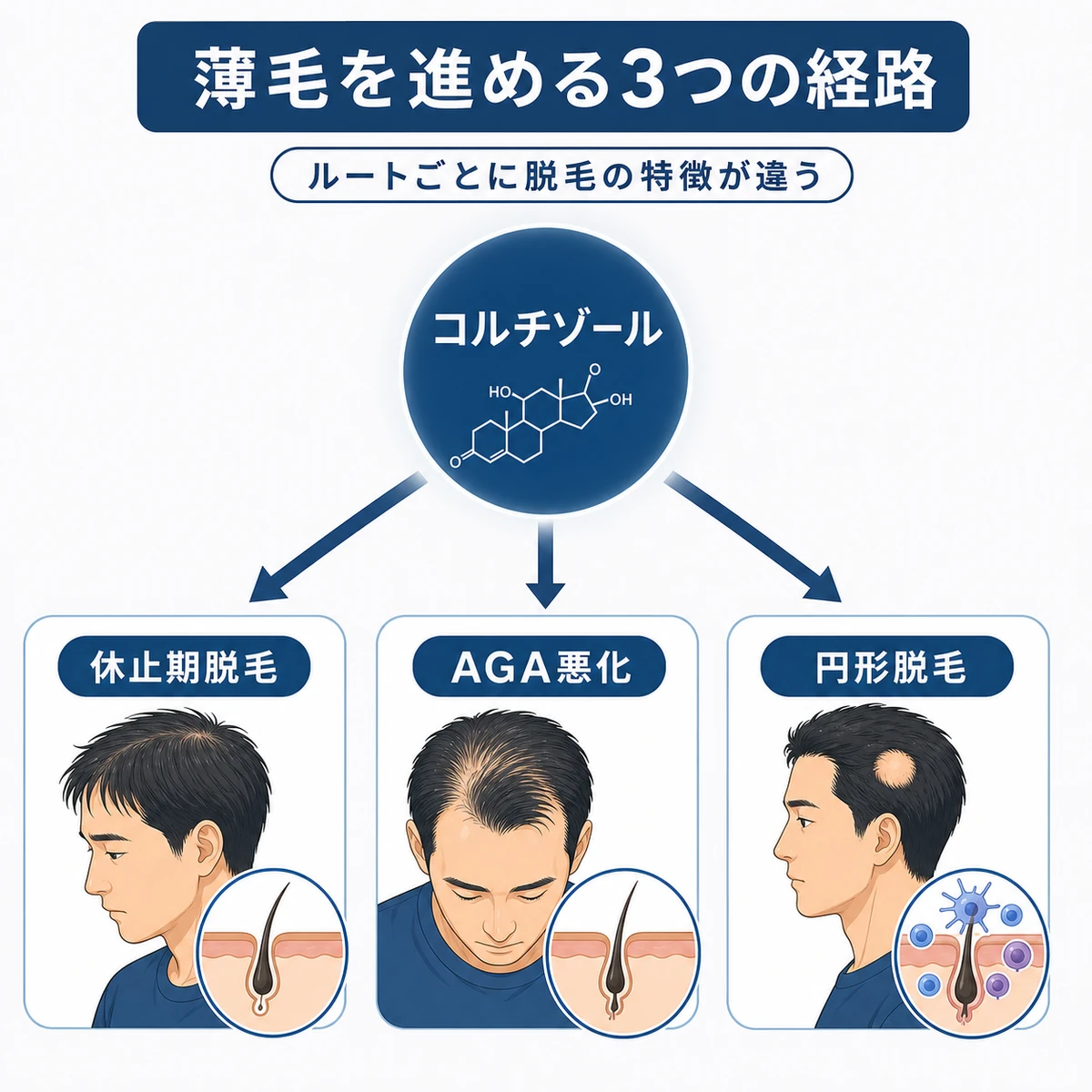 コルチゾールが薄毛を加速させる3つの経路を表した医療イラスト