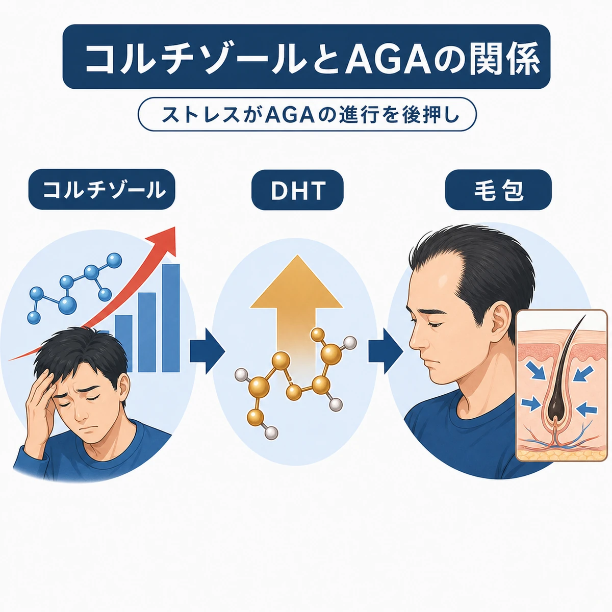 コルチゾールがDHTを介してAGAに関わる流れを示した医療イラスト