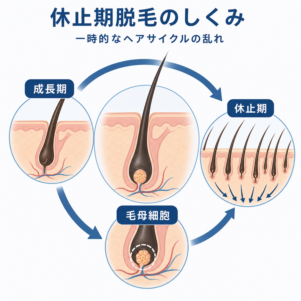 毛髪が一斉に休止期へ移る休止期脱毛のしくみを毛根の断面で表した医療イラスト