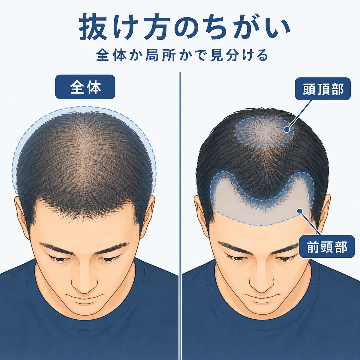 コロナ脱毛とAGAの抜け方の違いを成人男性の頭部で左右に比べた医療イラスト