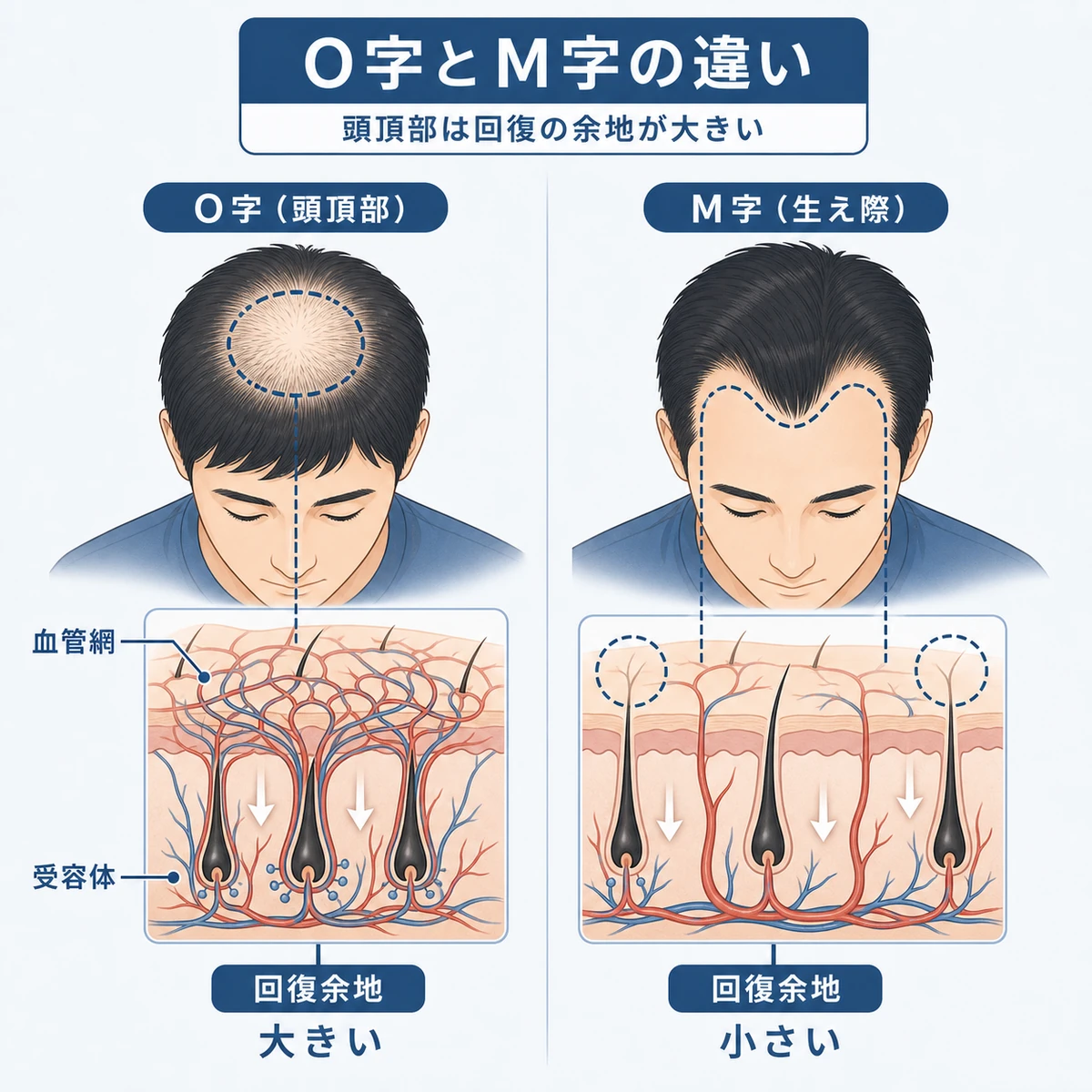 頭頂部のO字と生え際のM字で血管構造と回復しやすさを比べた医療イラスト