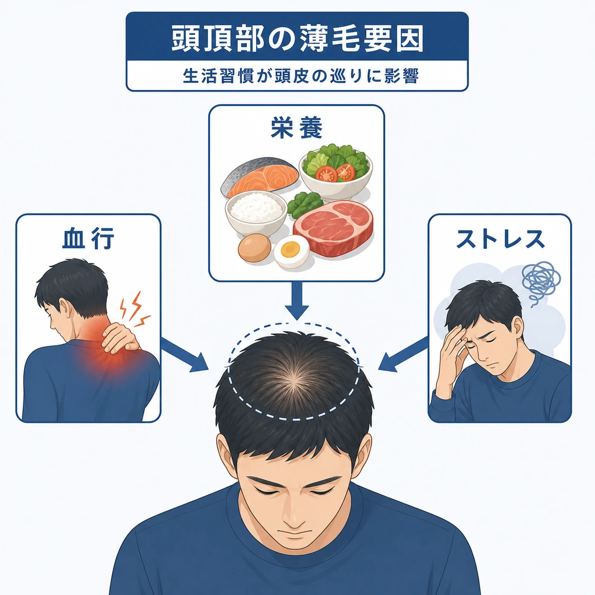 首肩のこり・栄養不足・ストレスが頭頂部の薄毛につながる要因を結んだ医療イラスト