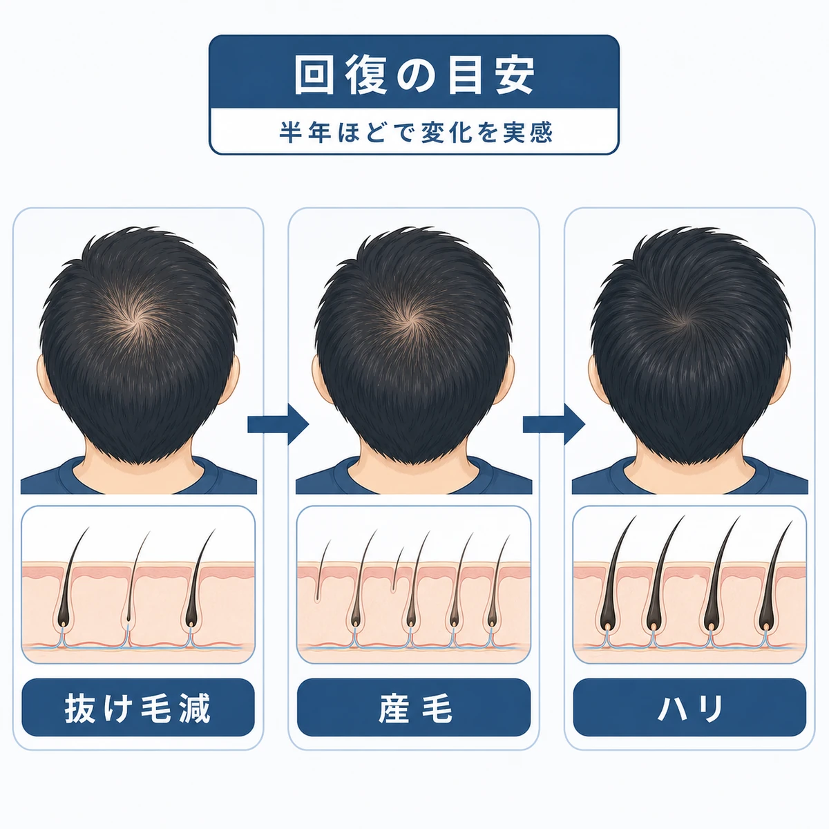 頭頂部の回復を3段階のタイムラインで表した期間の目安の医療イラスト