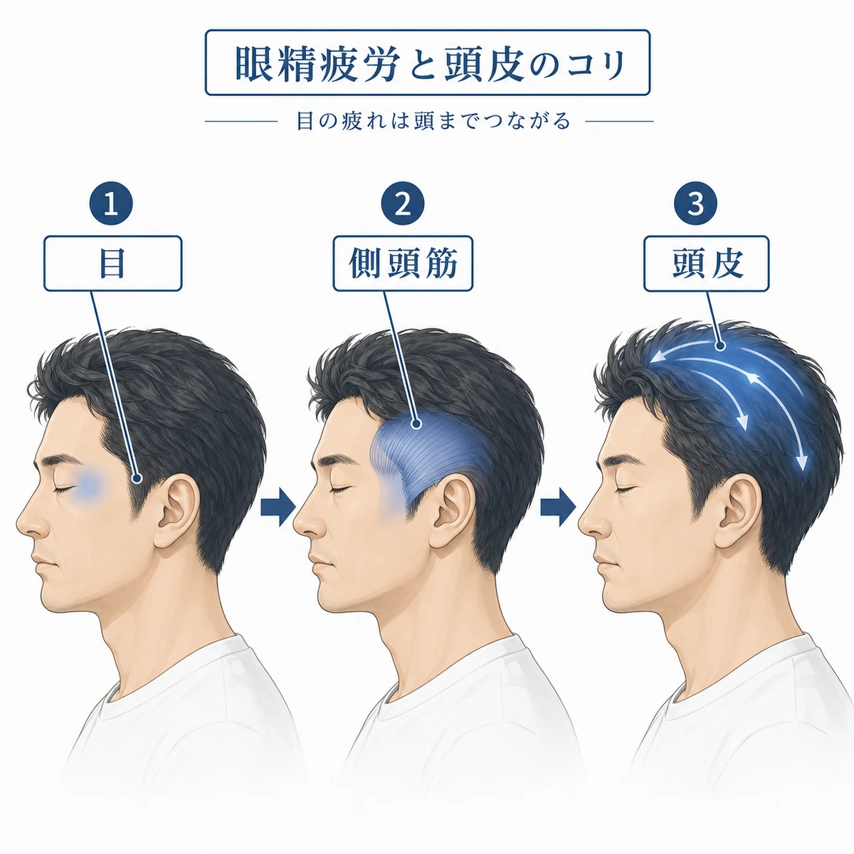 目の疲れが側頭筋を通じて頭皮へ広がる仕組みを示した医療イラスト