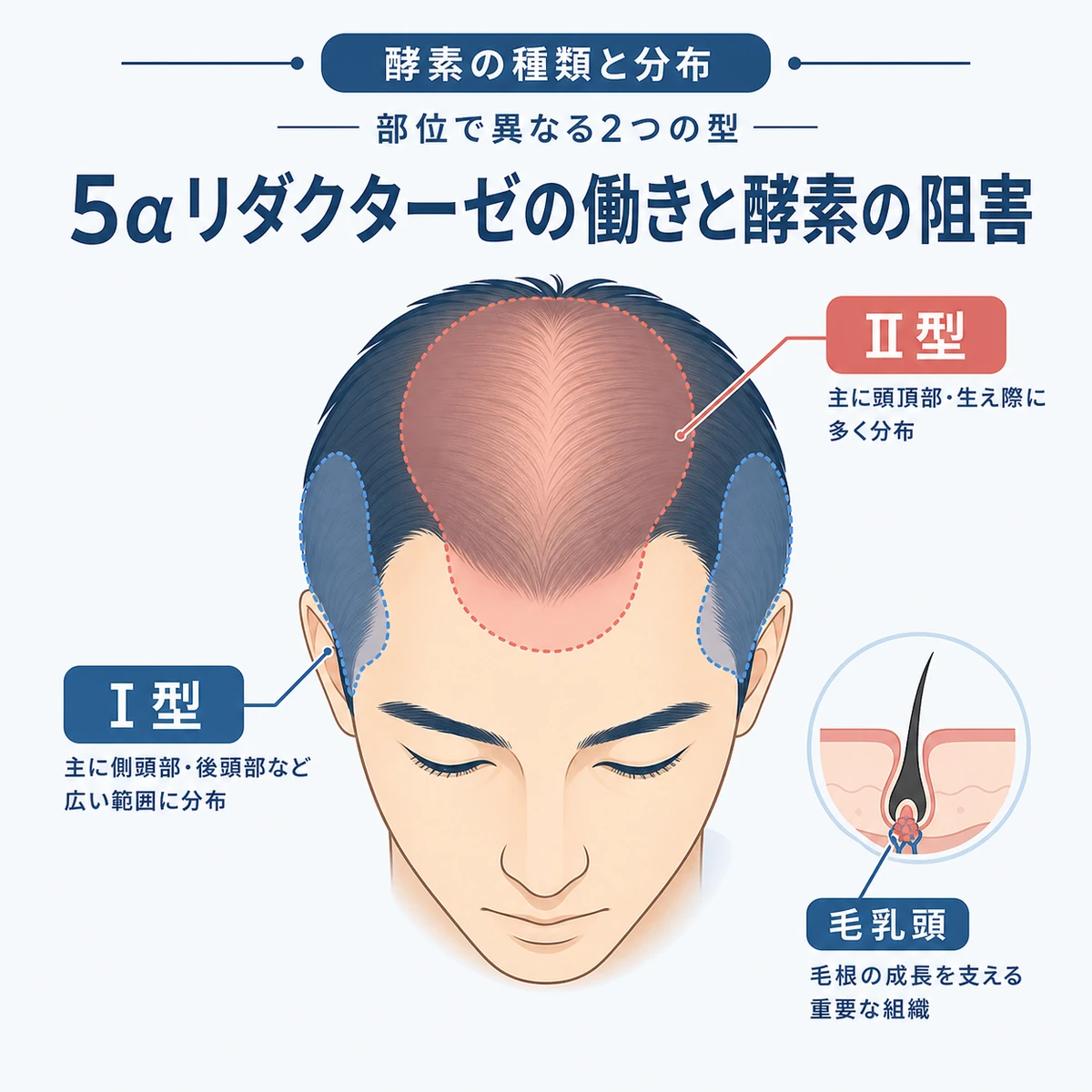5αリダクターゼのⅠ型とⅡ型が頭皮で分布する位置を示した医療イラスト