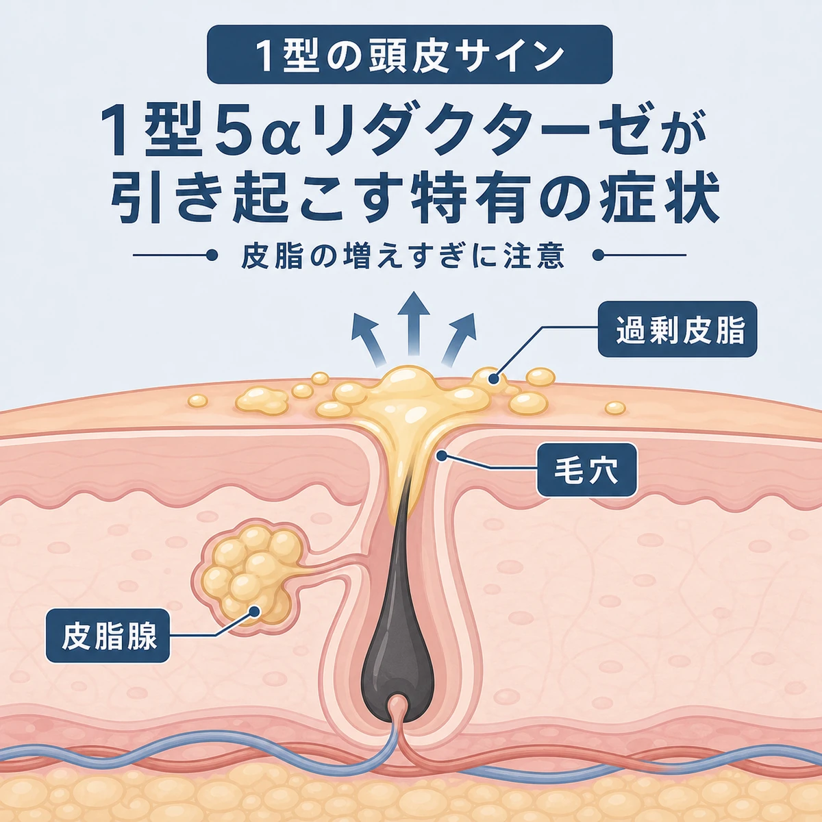 1型による過剰な皮脂分泌で毛穴がふさがれる頭皮の断面を表した医療イラスト