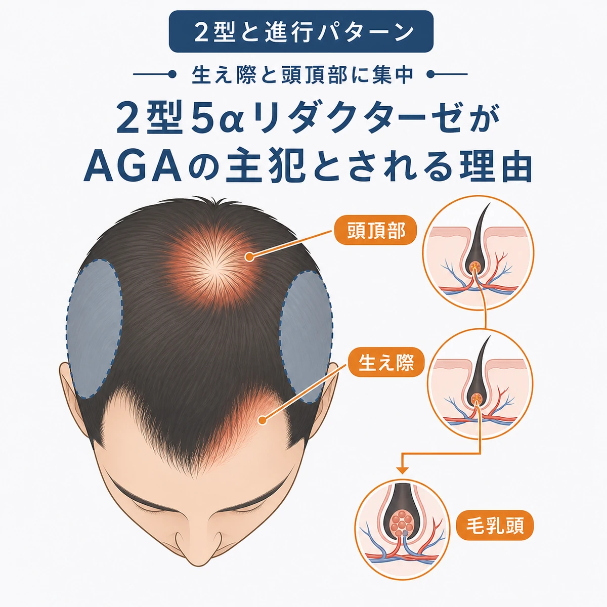 2型が生え際と頭頂部に集中して薄毛を進める分布を表した医療イラスト
