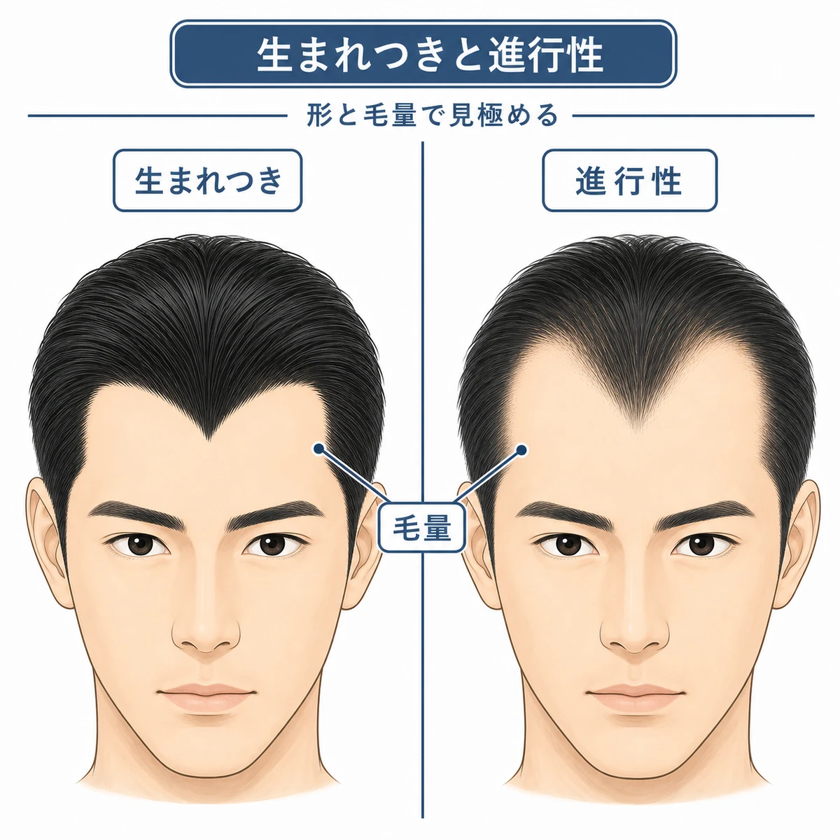 富士額とM字型の生え際の形の違いを左右で比べた医療イラスト