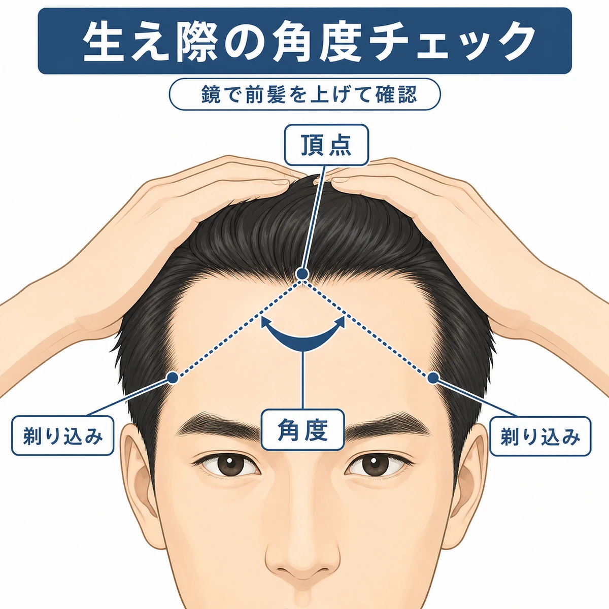額の頂点と剃り込みが作る生え際の角度をマークで示した自己診断の医療イラスト