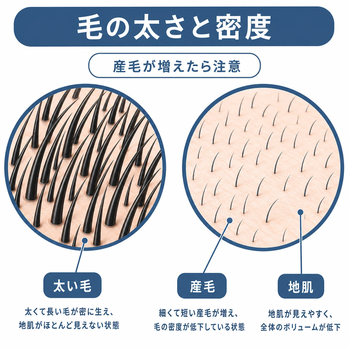 太い毛と産毛の密度の違いを頭皮の拡大で比べた医療イラスト