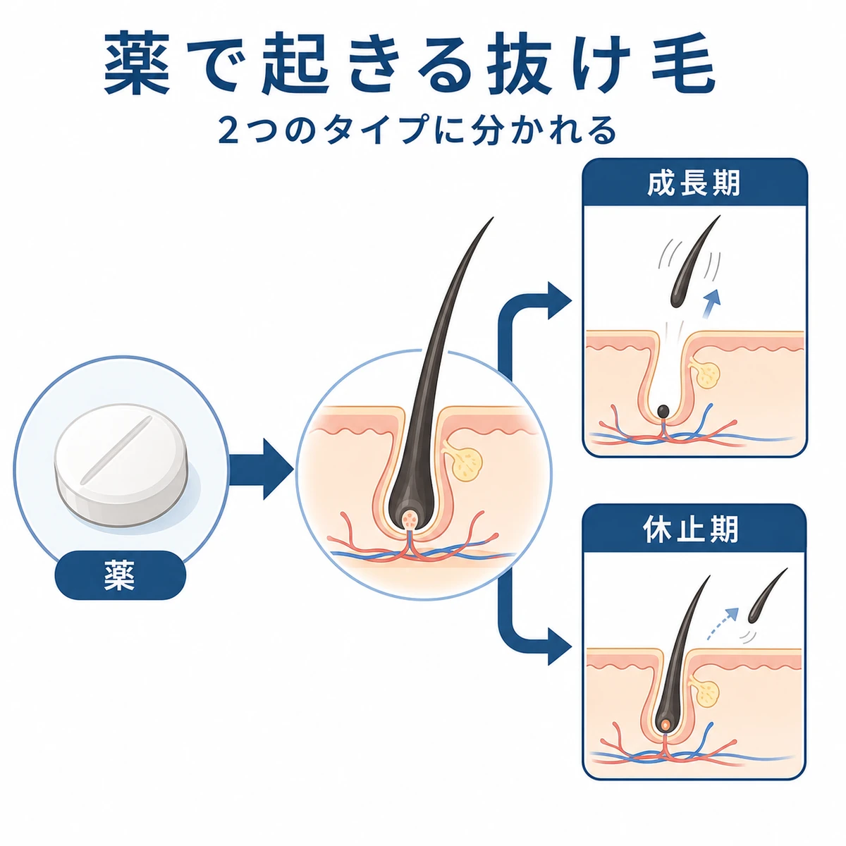 薬が毛根に作用し成長期脱毛と休止期脱毛の2タイプに分かれる仕組みを表した医療イラスト