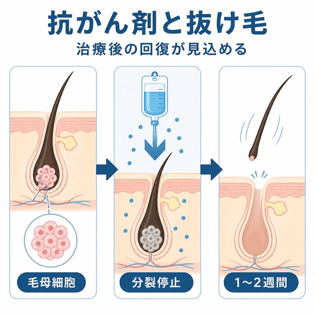 抗がん剤が毛母細胞の分裂を止め短期間で脱毛が進む経過を表した医療イラスト
