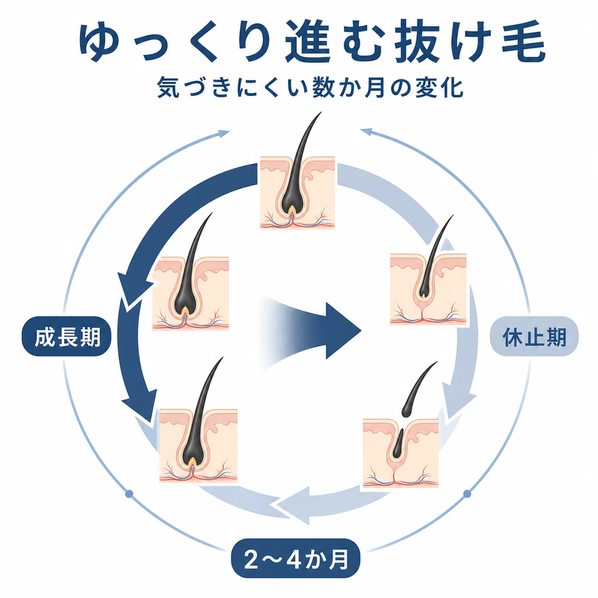 薬の影響で成長期が短縮し休止期脱毛がゆっくり進むヘアサイクルを表した医療イラスト
