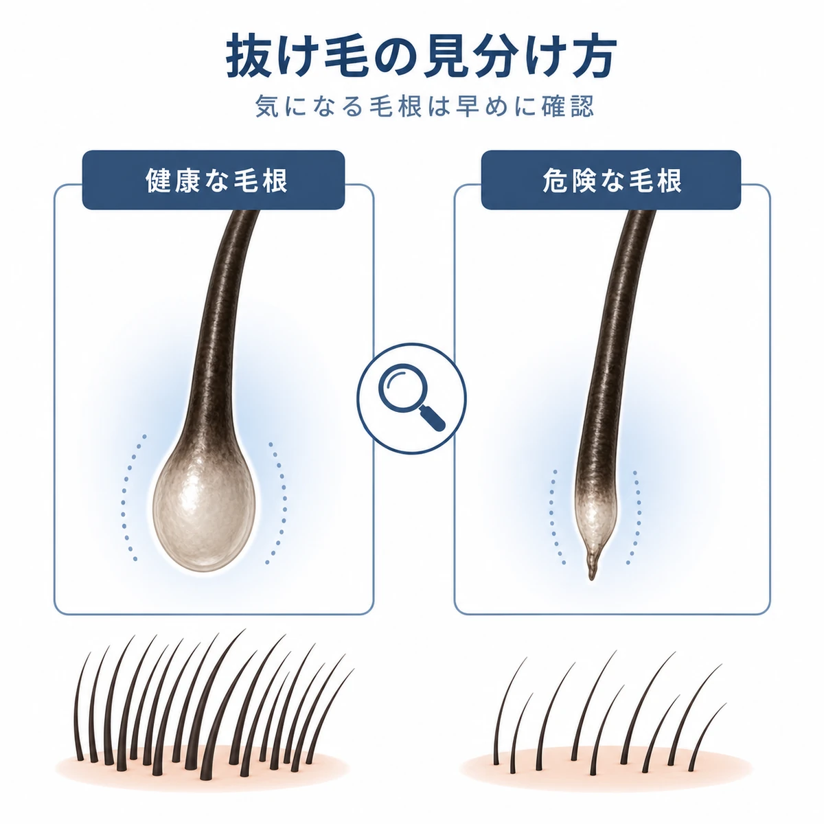 健康な毛根と危険な毛根の形状の違いを比較した医療イラスト