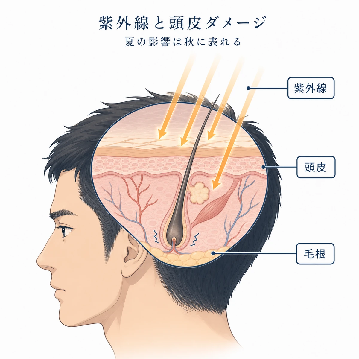 夏の紫外線が成人男性の頭皮内部の毛根に届くダメージを表した断面イラスト