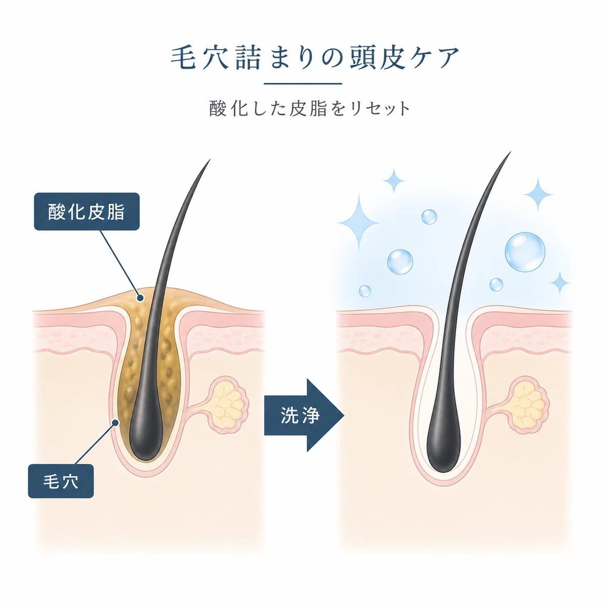 酸化した皮脂で詰まった毛穴と洗浄後の清潔な毛穴を比較した医療イラスト