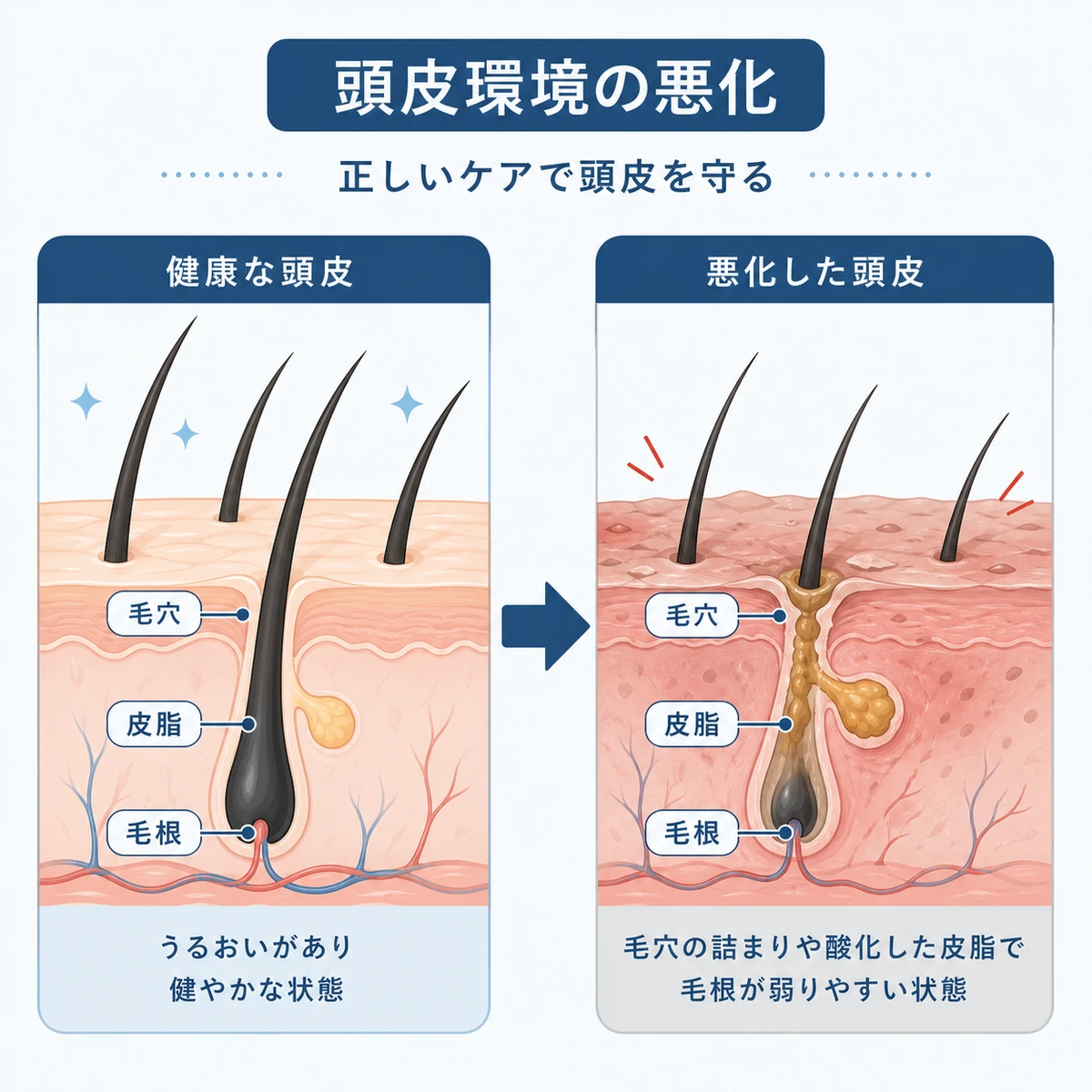 健康な頭皮と紫外線や皮脂で荒れた頭皮の断面を比べた医療イラスト