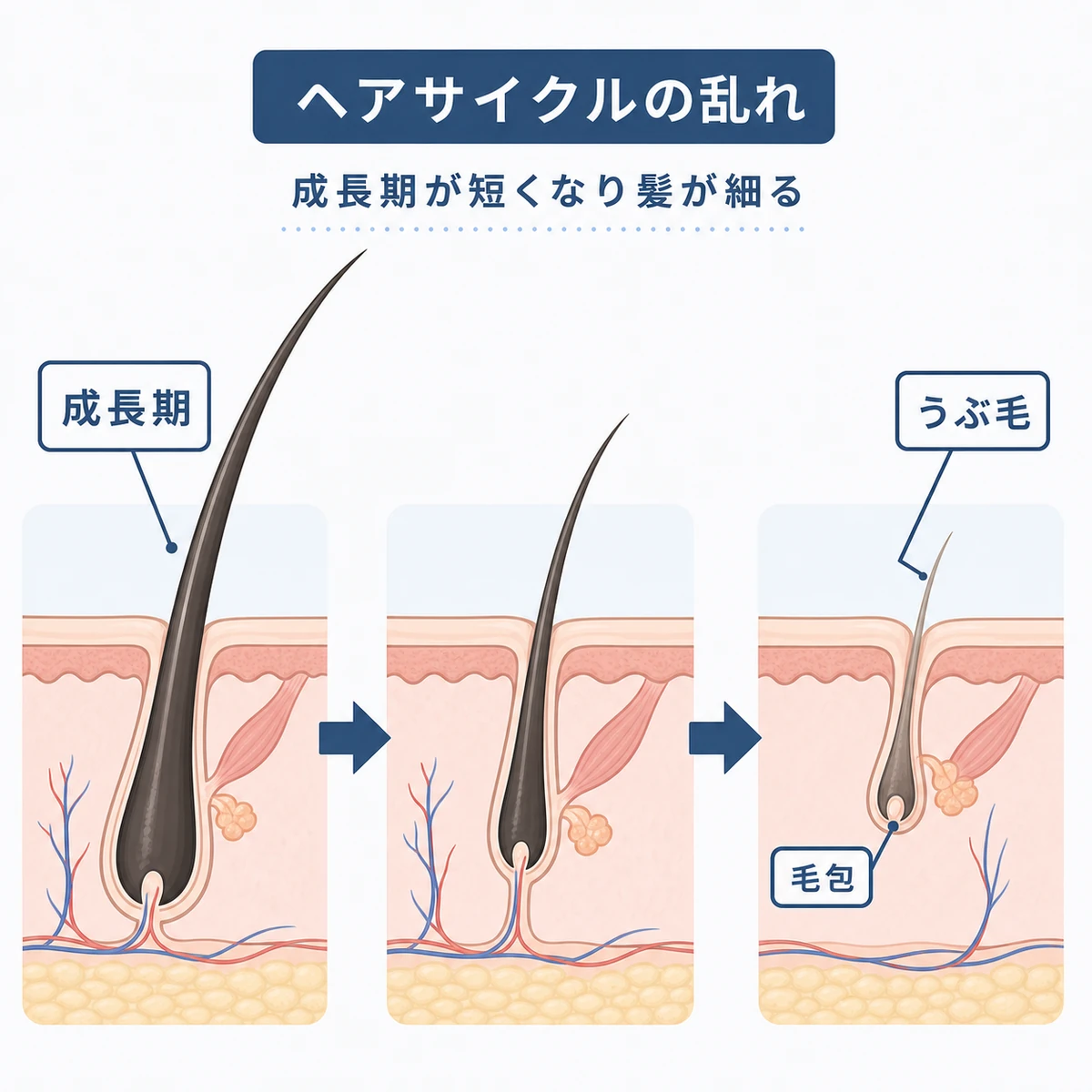 髪が太い毛から細いうぶ毛へ変化する毛周期の乱れを表した医療イラスト