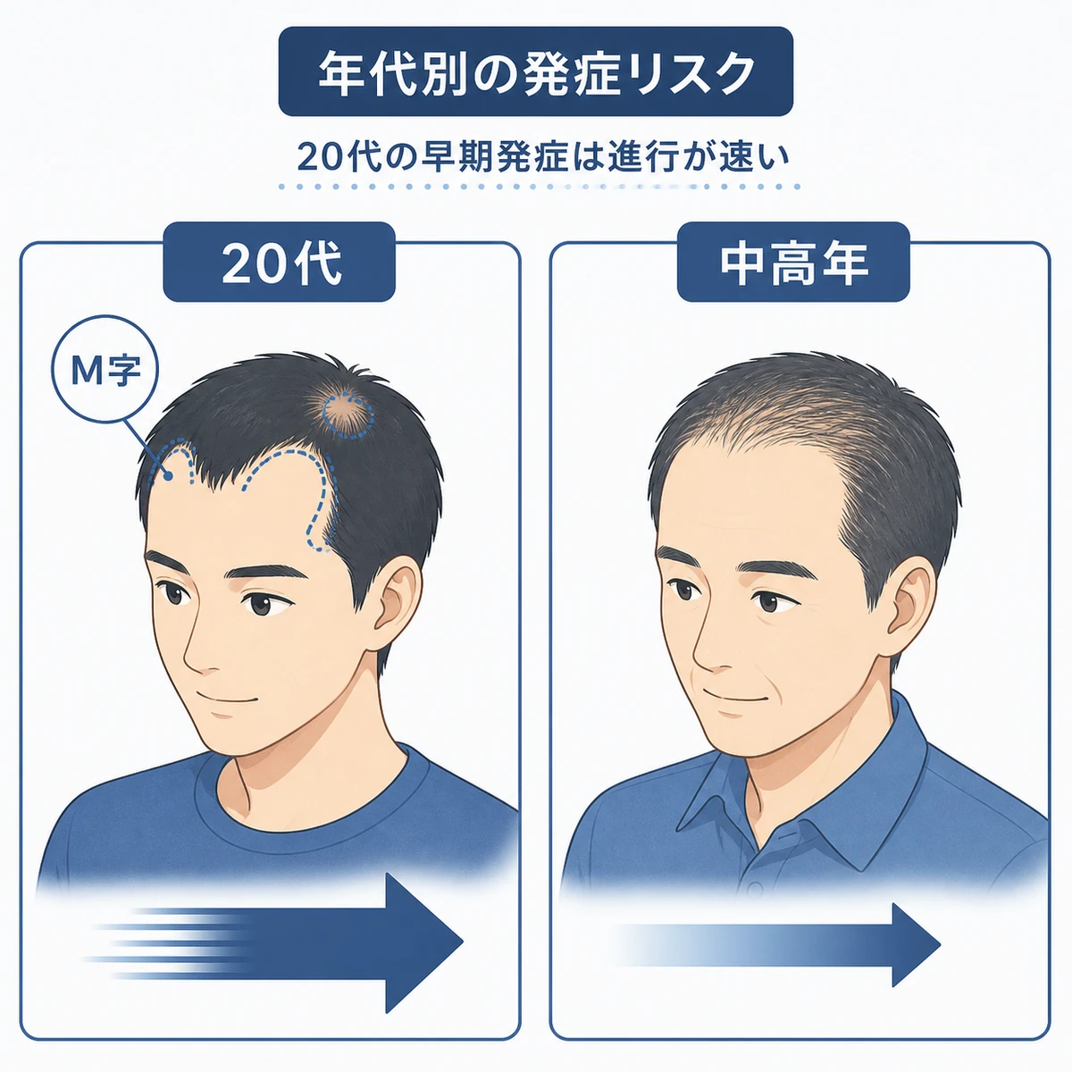 20代と中高年で薄毛の進行パターンと速度が異なる様子を比べた医療イラスト