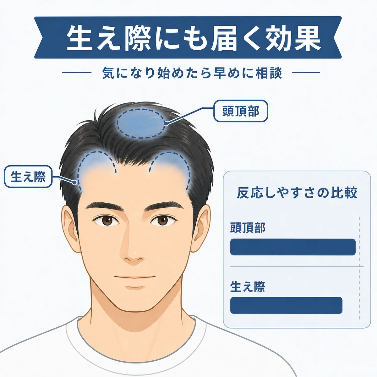 成人男性の生え際と頭頂部でフィナステリドの効果の出やすさを比べた医療イラスト