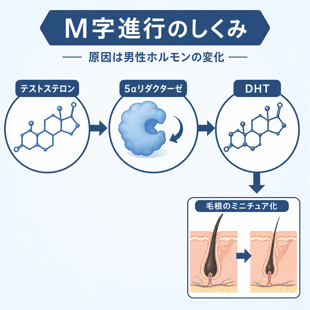 テストステロンがDHTに変わり生え際の毛根に影響するM字はげの原因を表した医療イラスト