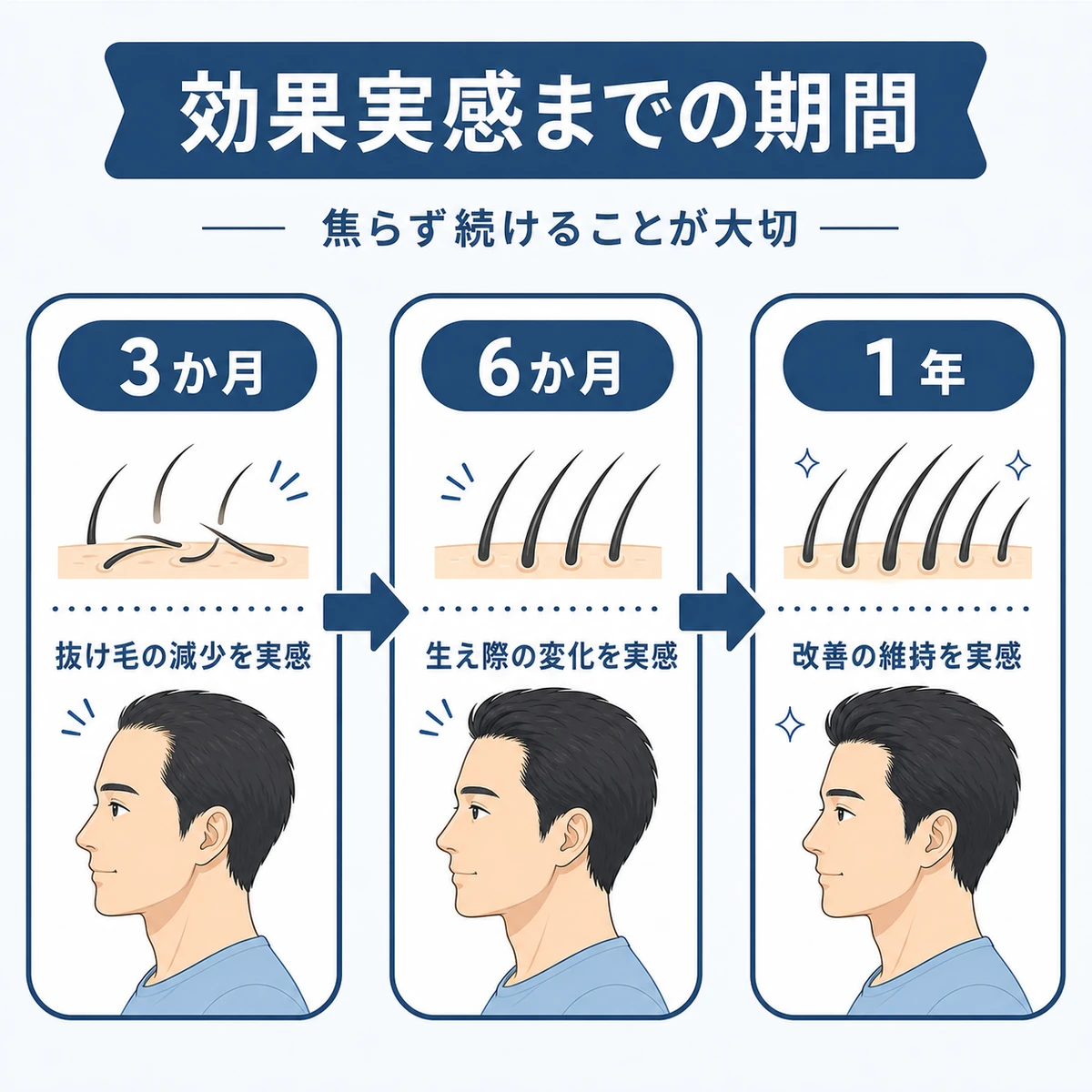 フィナステリドの効果を実感するまでの服用期間の流れを段階的に表した医療イラスト