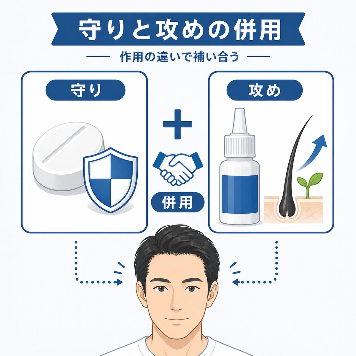 守りのフィナステリドと攻めのミノキシジルを併用する考え方を表した医療イラスト