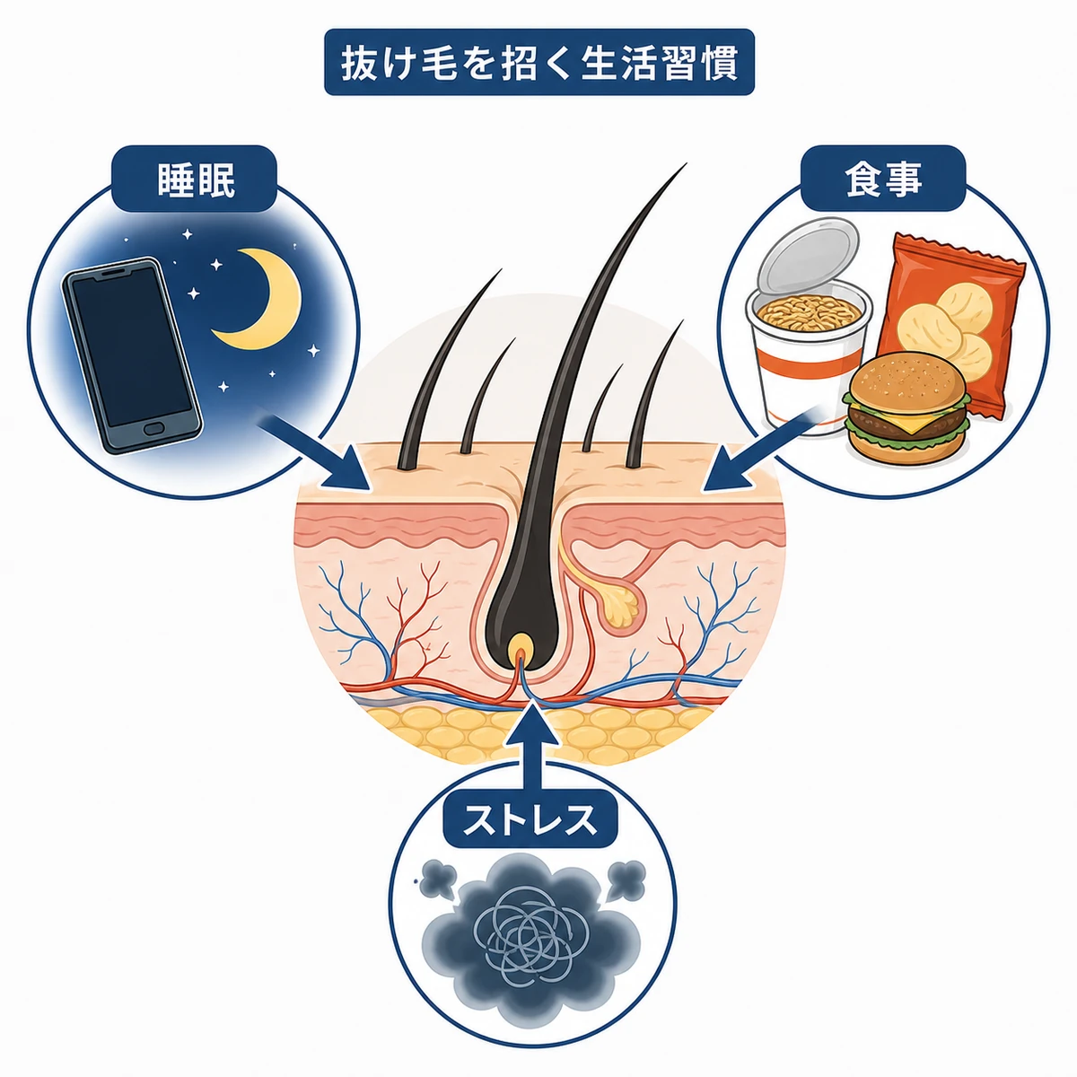 睡眠不足や偏食、ストレスが頭皮に影響する仕組みを表した医療イラスト