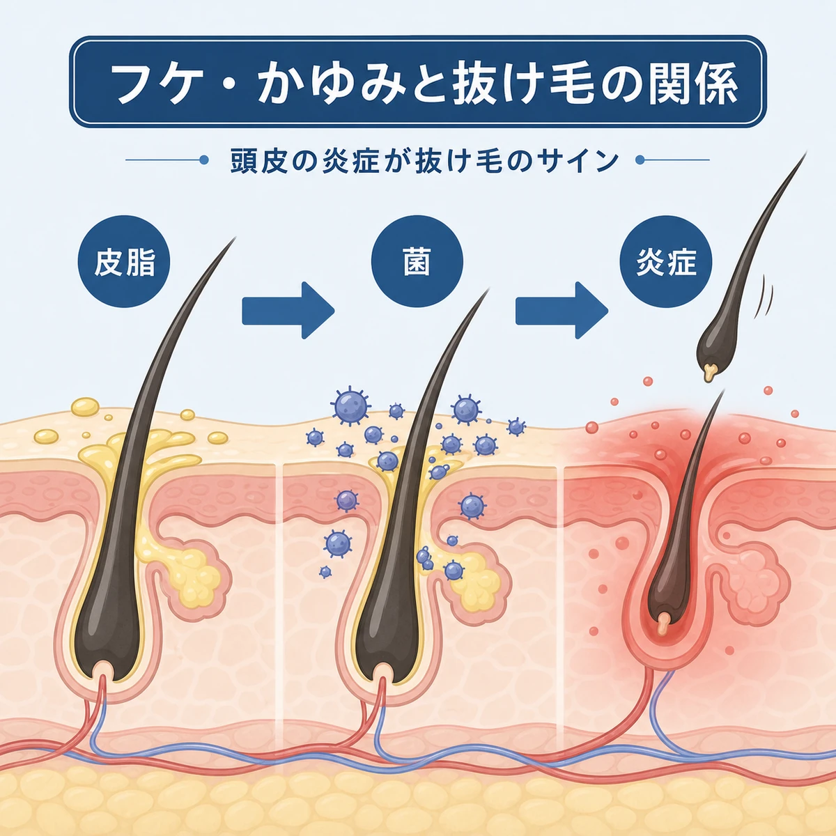 皮脂の過剰分泌から菌の増殖と炎症を経て抜け毛につながる頭皮の仕組みを表した医療イラスト