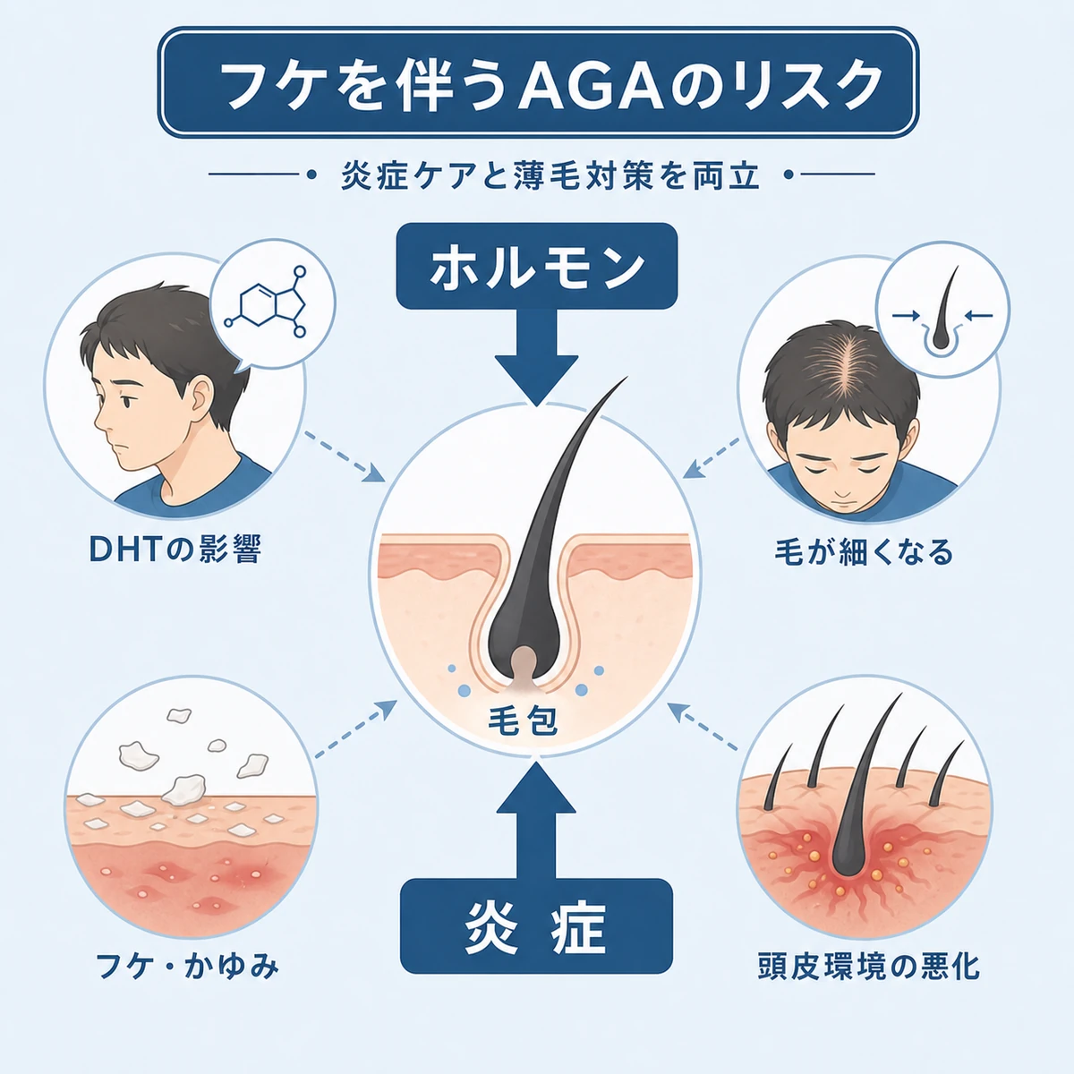 ホルモンと炎症が同時に毛根を傷める併発時の二重リスクを表した医療イラスト