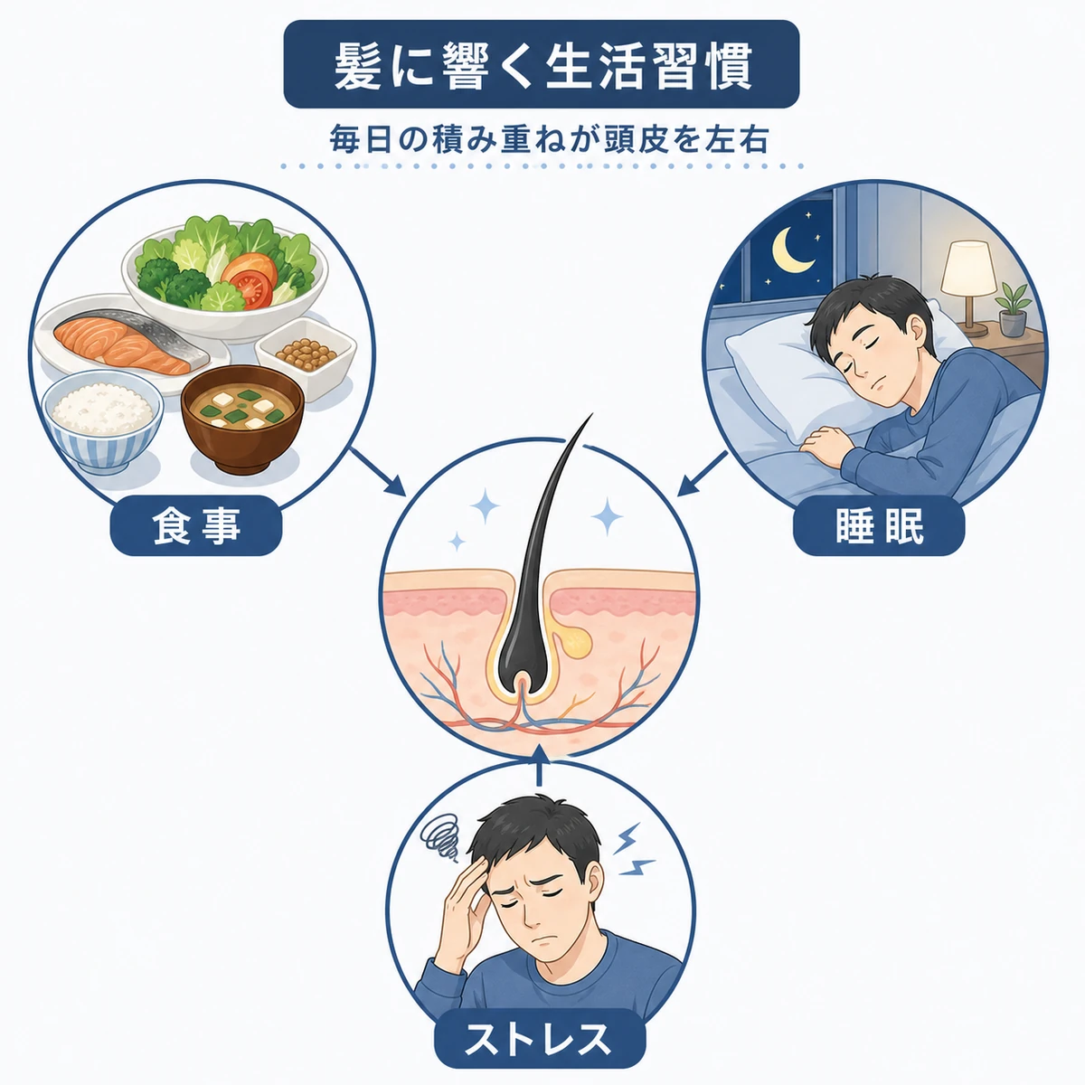 食事や睡眠やストレスといった生活習慣が頭皮と毛根に与える影響を表した医療イラスト