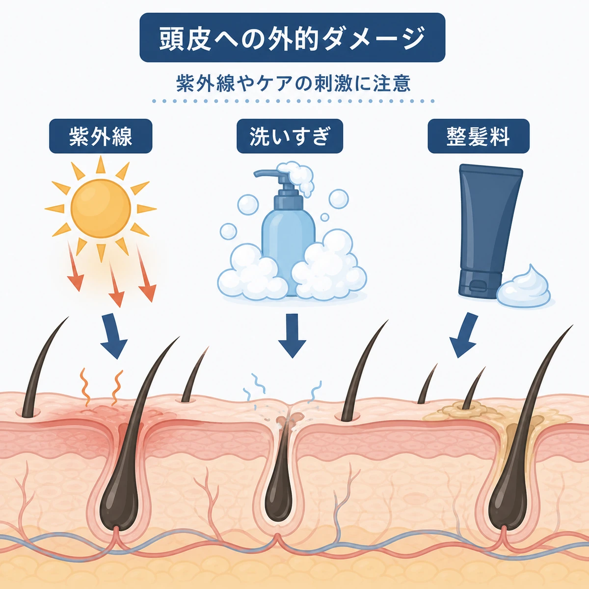 紫外線や誤ったヘアケアが頭皮の断面に与える外的ダメージを表した医療イラスト