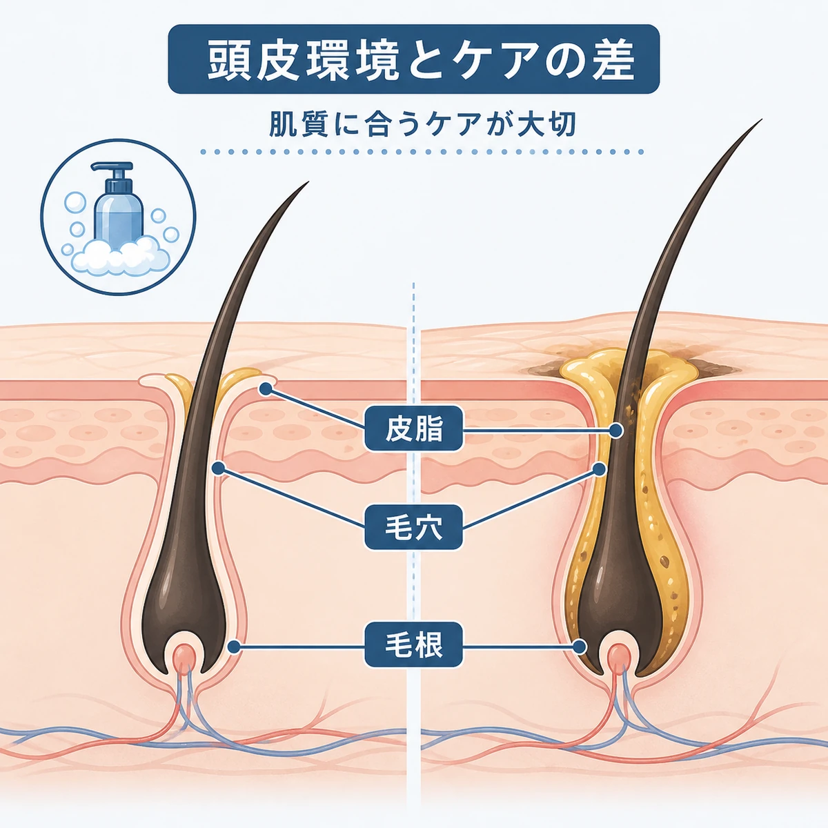 頭皮の皮脂や毛穴の状態とヘアケアの関係を示した断面の医療イラスト