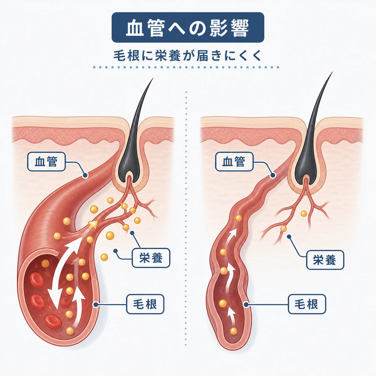 喫煙や飲酒で毛細血管が収縮し毛根への栄養が滞るしくみを表した医療イラスト