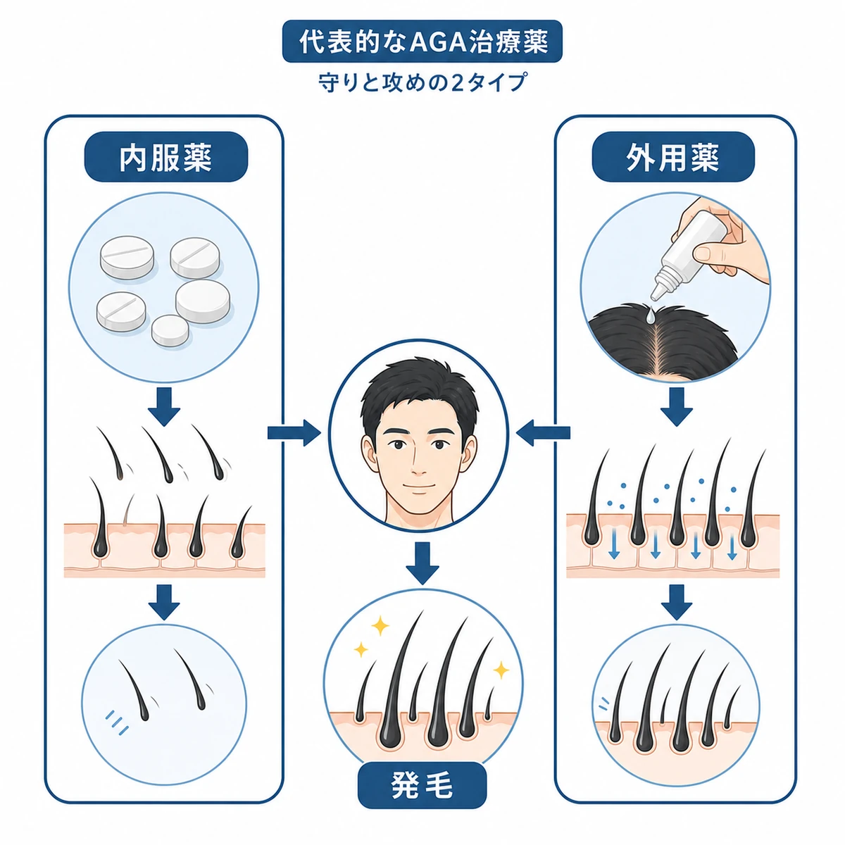 抜け毛を抑える内服薬と発毛を促す外用薬を左右で対比したAGA治療薬の医療イラスト