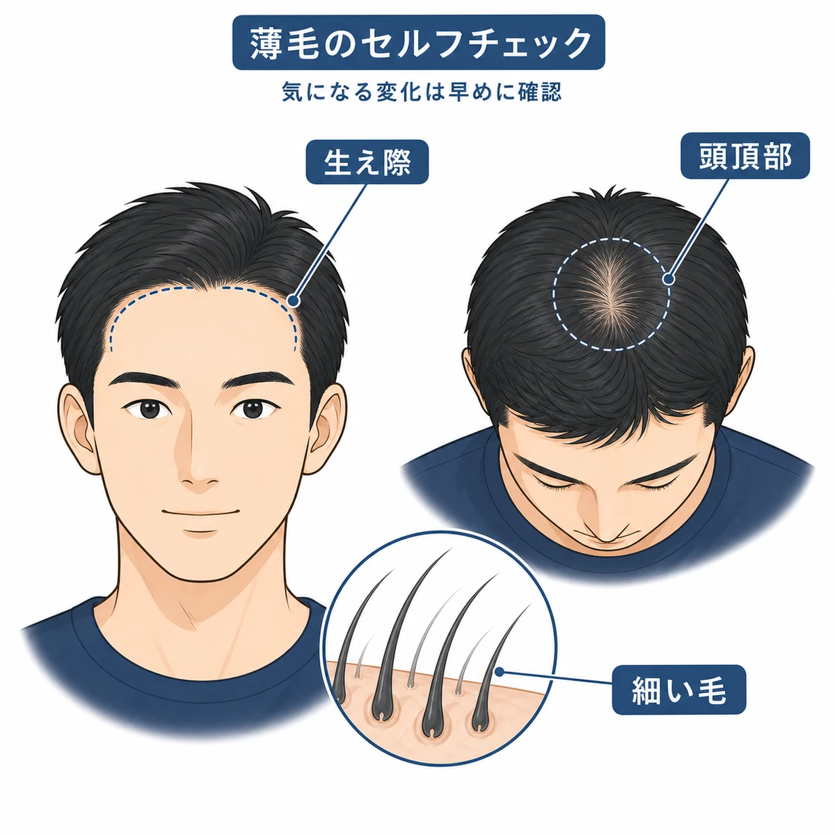 20代男性が自分の薄毛サインを確認するポイントを示した医療イラスト