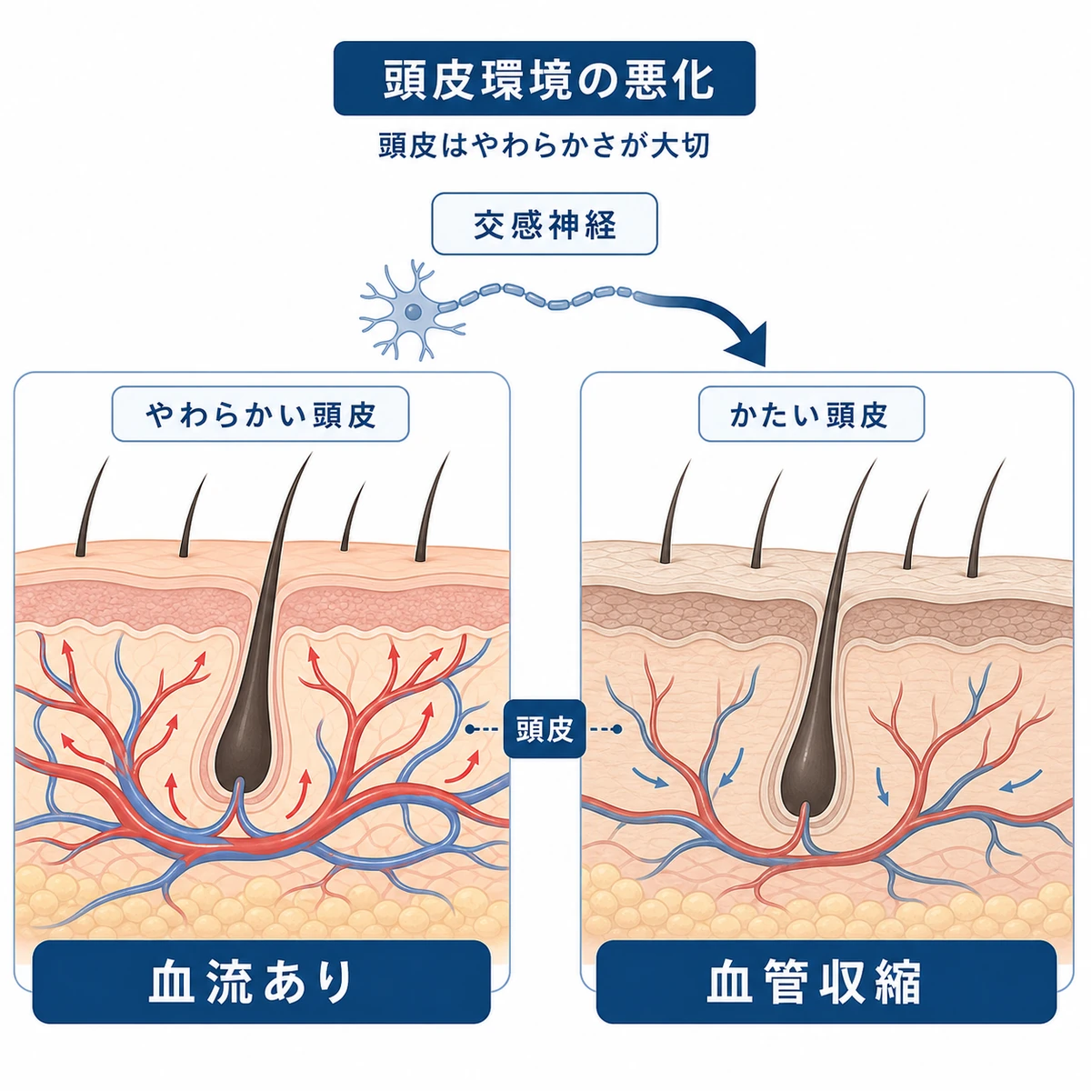 自律神経の乱れで頭皮の血管が収縮し頭皮環境が悪化する様子を断面で比べた医療イラスト