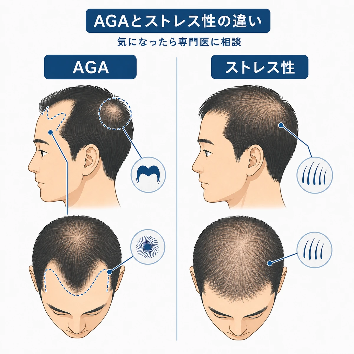 AGAとストレス性の抜け毛の進み方の違いを男性の頭部で比べた医療イラスト
