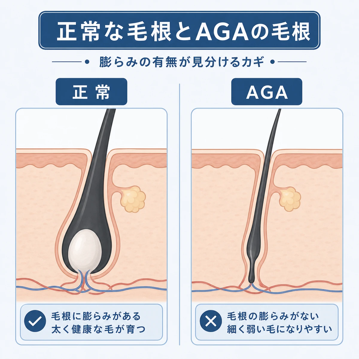 ふっくらした正常な毛根と萎縮したAGAの毛根の形の違いを左右で比べた医療イラスト