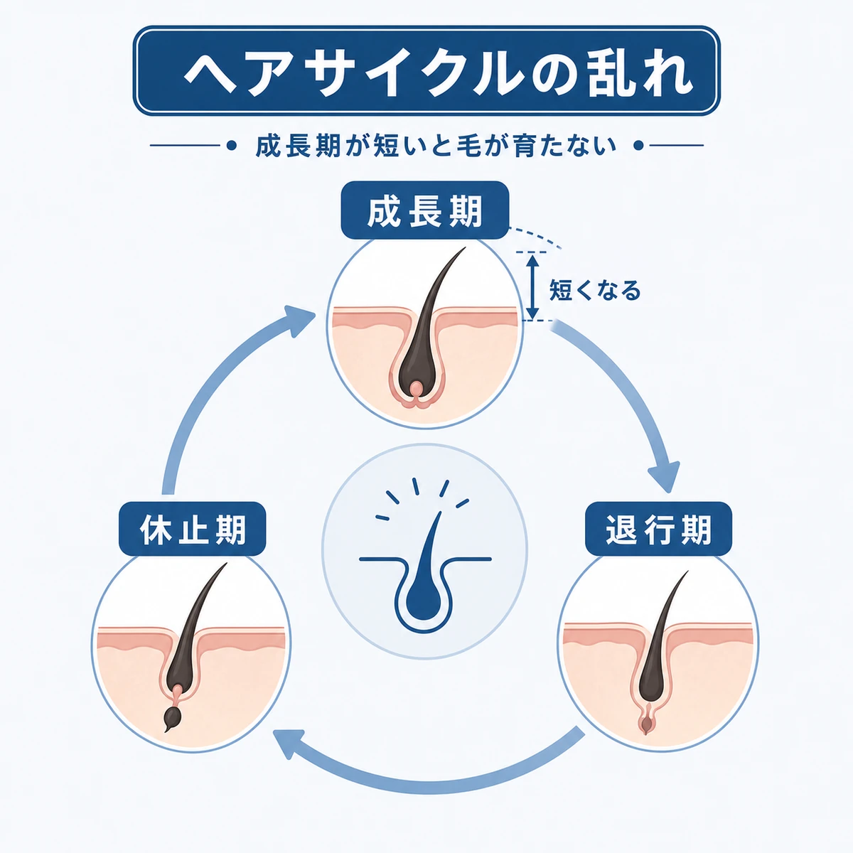 ヘアサイクルが短縮して毛根が十分に育たなくなる流れを表した医療イラスト