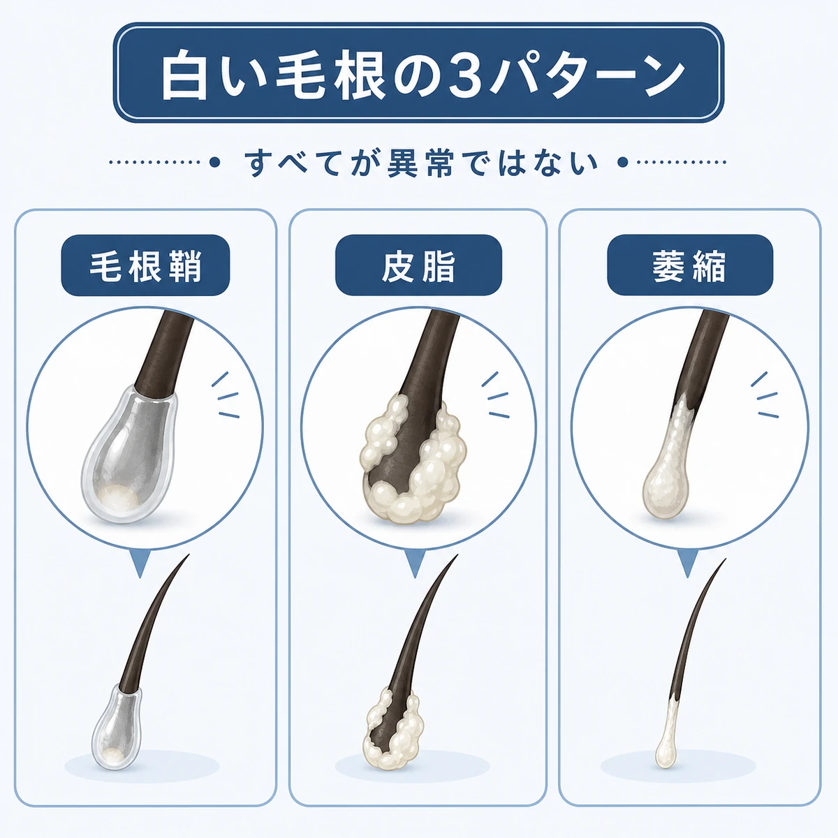 白い毛根を毛根鞘・皮脂・萎縮の3つのパターンに分けて比べた医療イラスト
