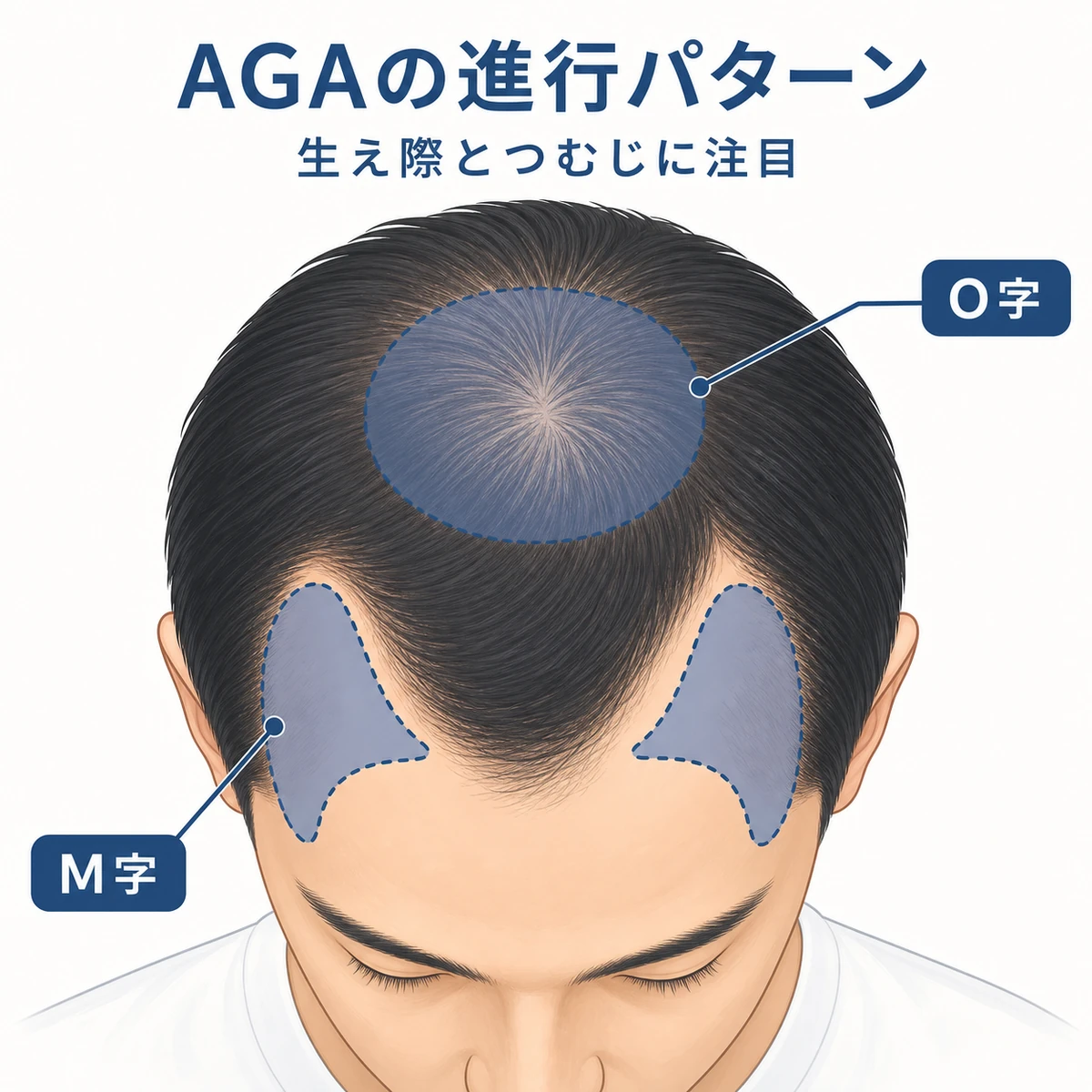 AGAのM字型とO字型の薄毛パターンを一つの頭部で比較した医療イラスト