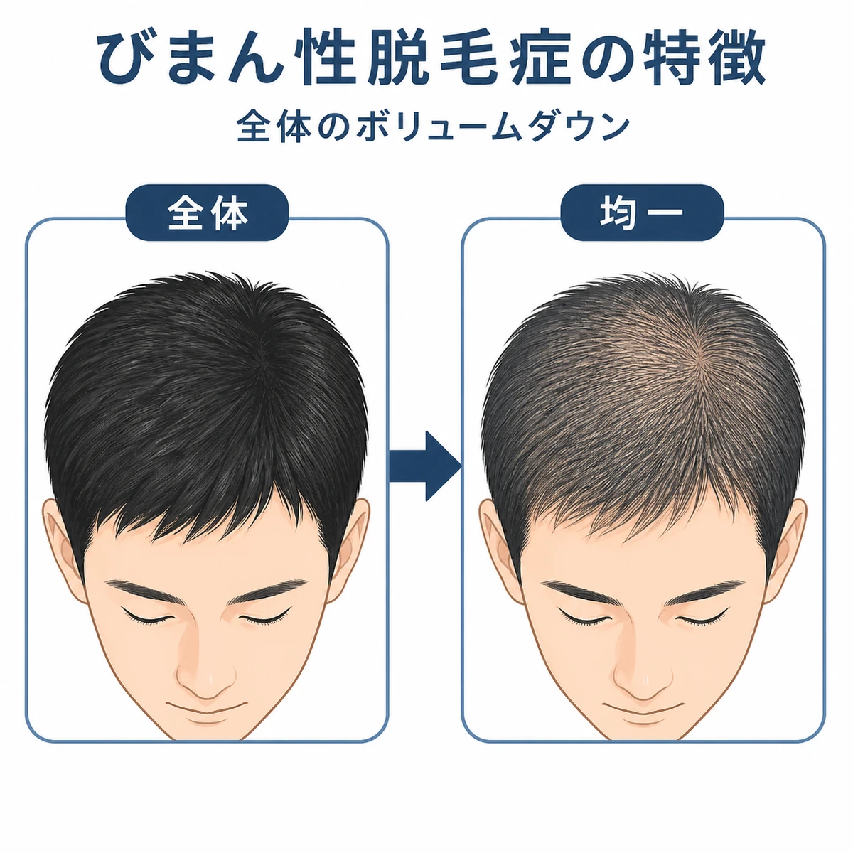 びまん性脱毛症で頭部全体のボリュームが均一に減る変化を比較した医療イラスト