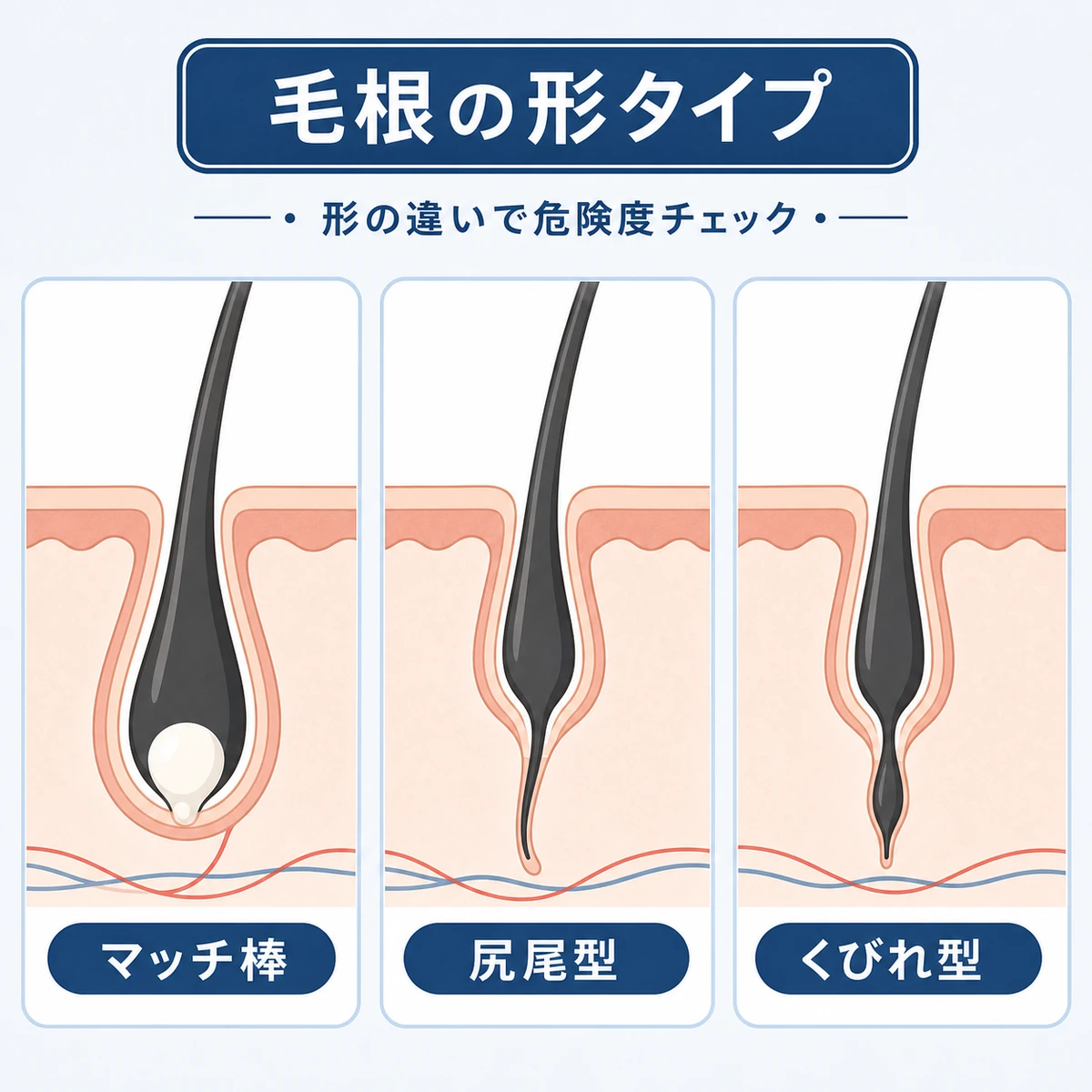 マッチ棒型と尻尾型とくびれ型に分けた毛根の形状パターンの医療イラスト