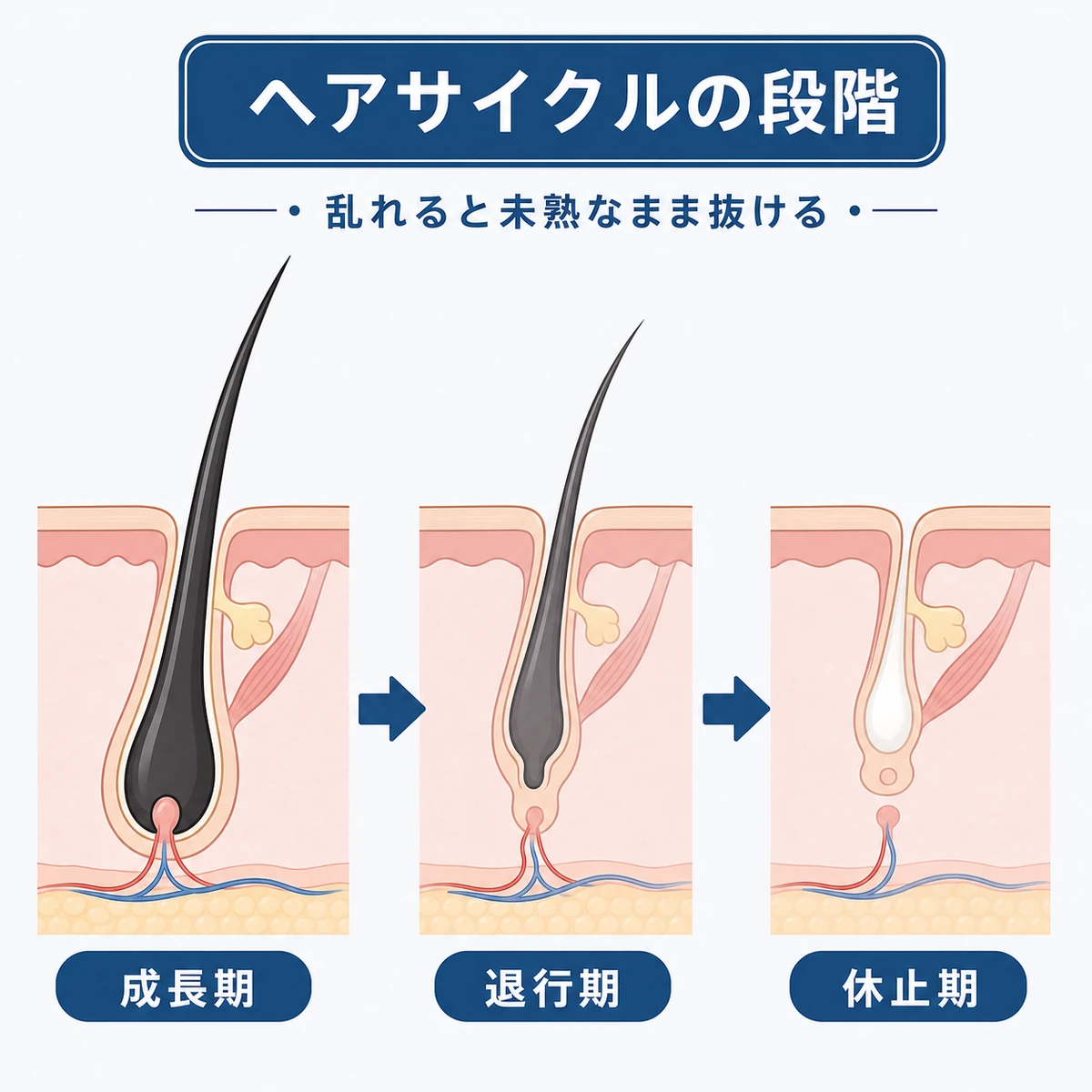 成長期から退行期と休止期へ移るヘアサイクルの流れを表した医療イラスト